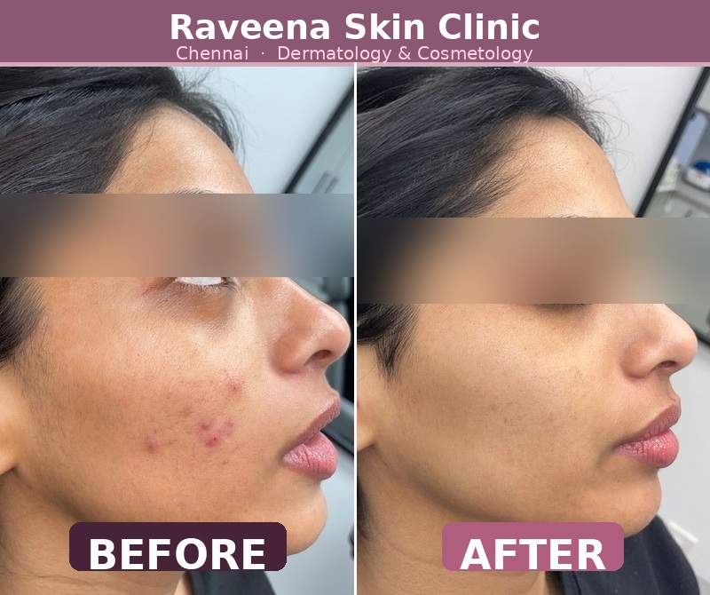 Before and after acne treatment result at Raveena Skin Clinic North Chennai