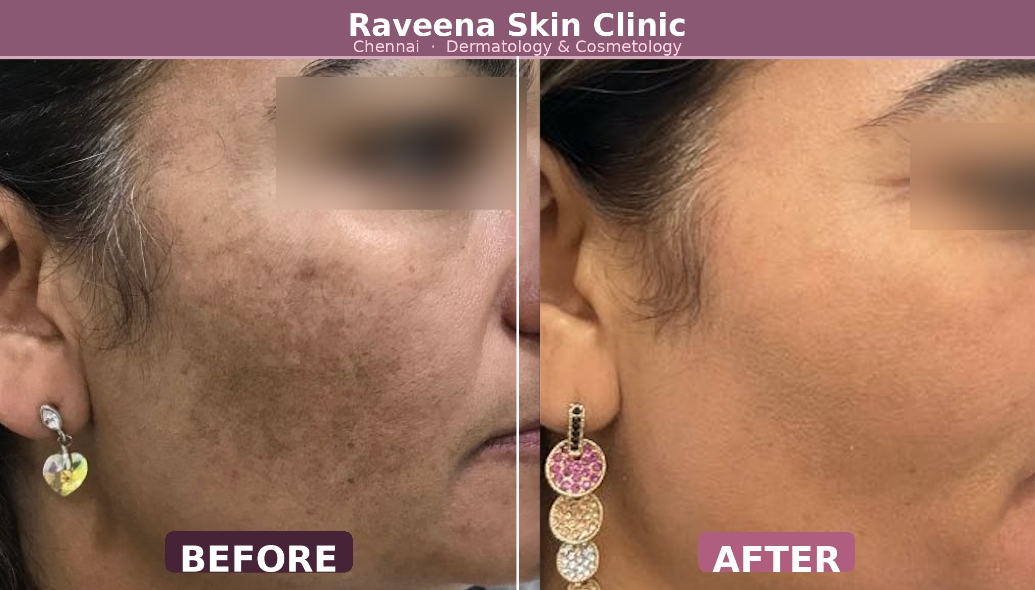 Before and after pigmentation treatment result Chennai