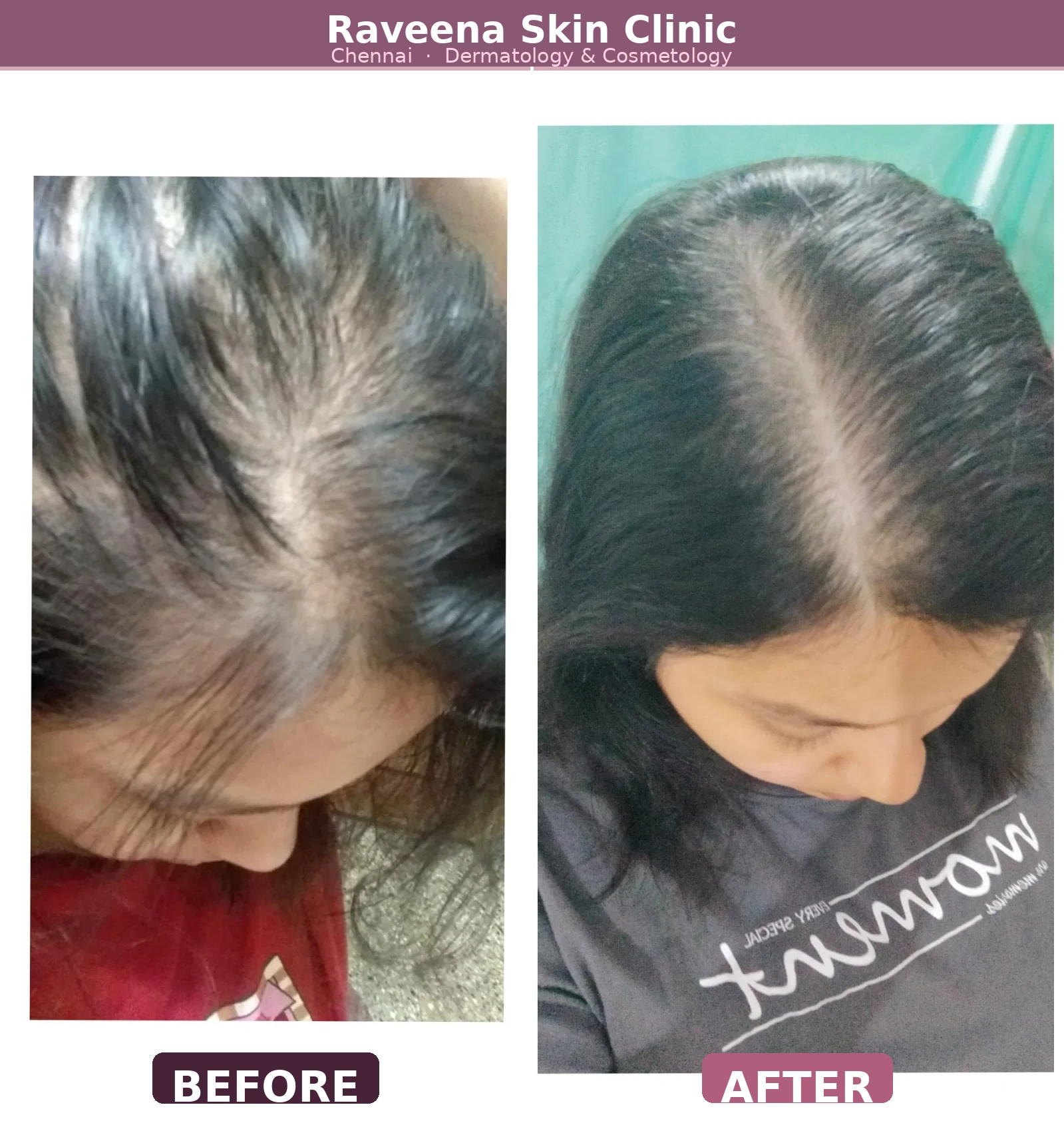 Before and after hair regrowth result at Raveena Skin Clinic Chennai
